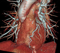 사진 64채널CT의 가상 심장영상 2