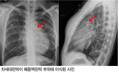 차세대판막이 폐동맥판막 부위에 이식된 사진