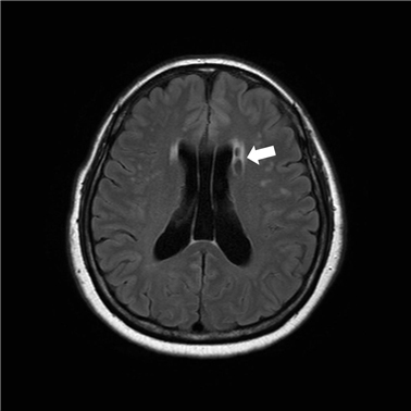 무증상 열공성 뇌경색 환자의 뇌 MRI 사진