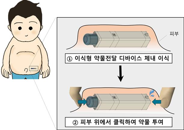 [이미지] 단 한 번의 이식 후 피부 위에서 손가락으로 클릭하면 정교한 양의 약물이 방출되는 디바이스