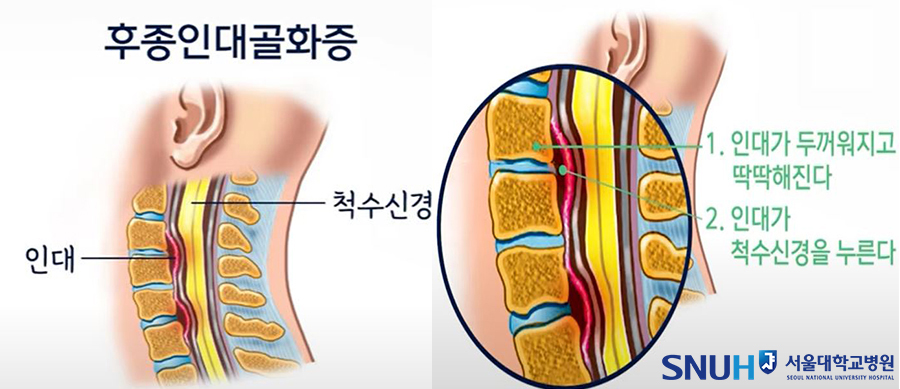 후종인대골화증의 발생 과정