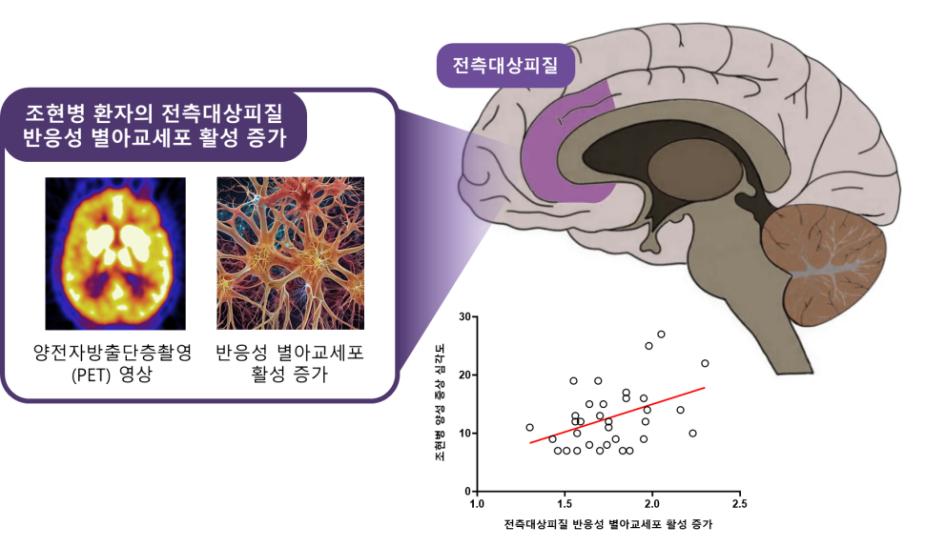 현병 환자의 뇌 속 전측대상피질에서 반응성 별아교세포(