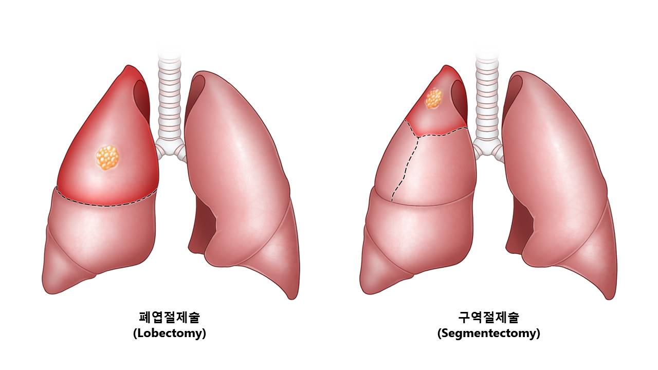 폐엽절제술 및 구역절제술