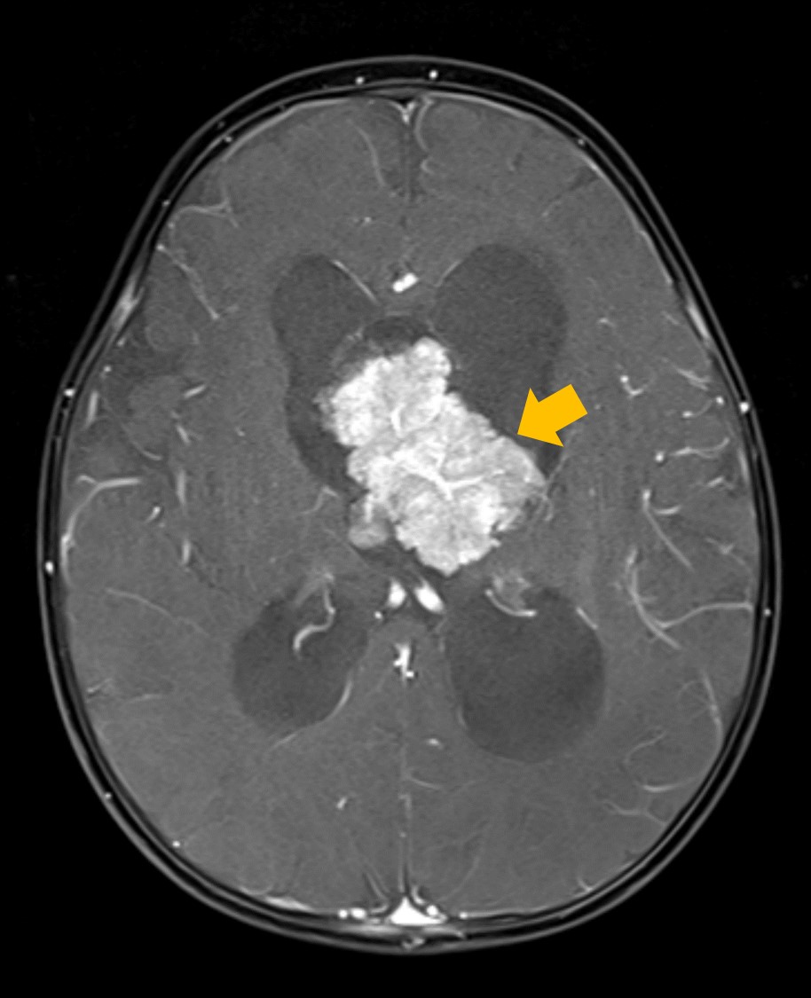 [이미지3] 맥락얼기유두종 뇌 MRI 