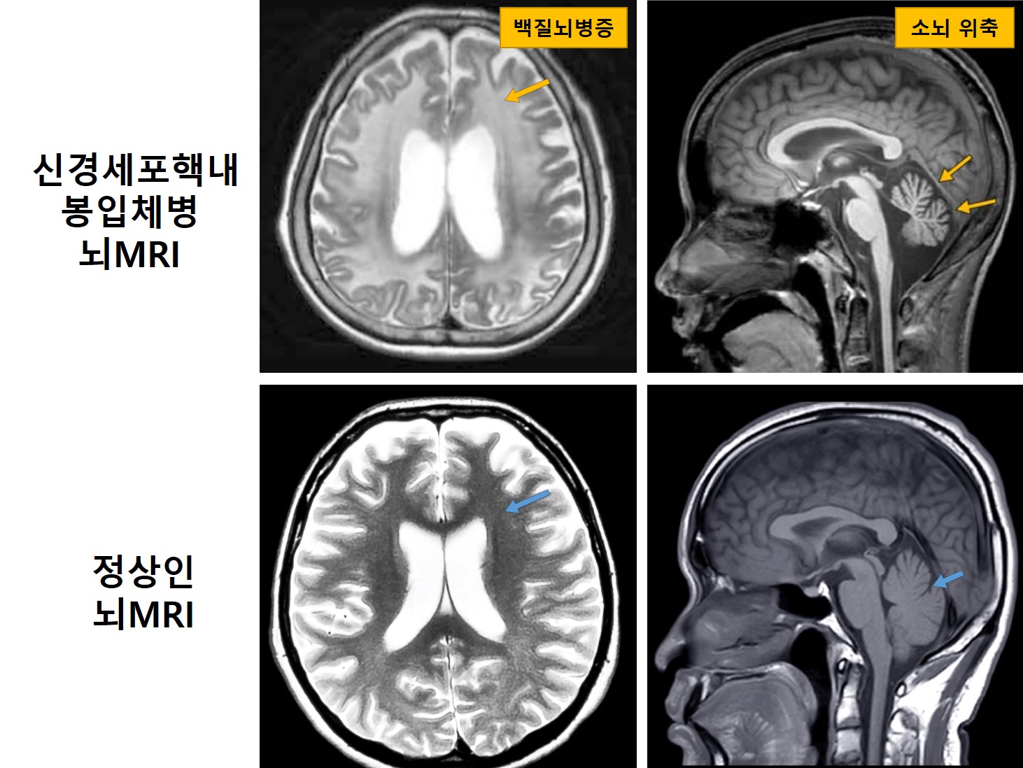 신경세포핵내봉입체병 환자(위)와 정상인(아래)의 뇌MRI 비교
