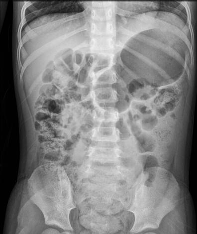 [이미지] 소아복부 x-ray (출처: 게티이미지뱅크) 