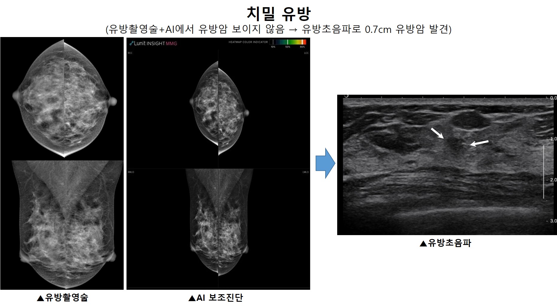 [사진] 치밀유방에서 유방촬영술과 AI로 보이지 않는 유방암(흰색 화살표)을 유방초음파로 발견