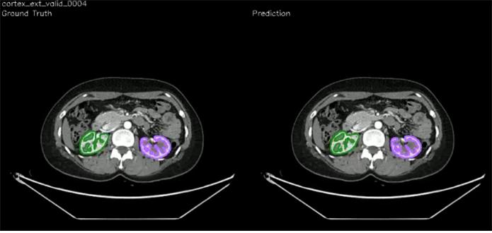 [그림1] 연구팀(좌측) 및 AI(우측)가 그린 신장 피질. AI 모델이 실제 신장 피질 부피를 매우 정확하게 측정할 수 있음