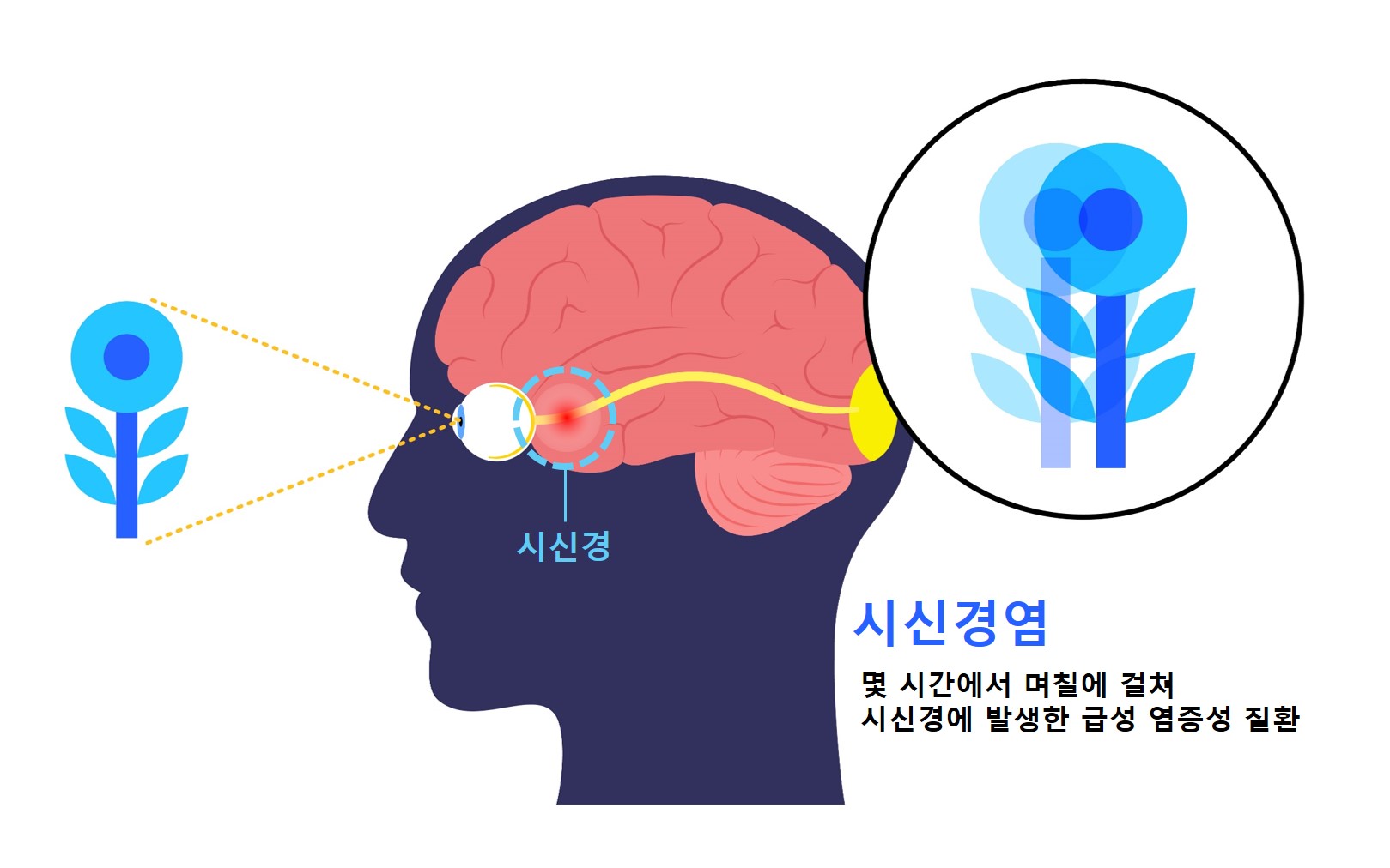 시신경염 (이미지 출처: 게티이미지뱅크)