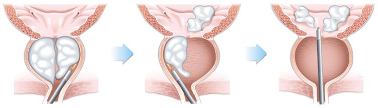 [그림1] 홀렙수술 모식도: 비대된 전립선 조직을 홀뮴레이저로 완전히 제거하는 ‘분리 적출술’ 방법