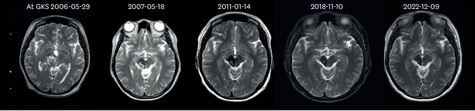 [그림1] 감마나이프 방사선 수술(GKS) 후 우측 중뇌 해면상 혈관종의 크기 변화를 보여주는 MRI