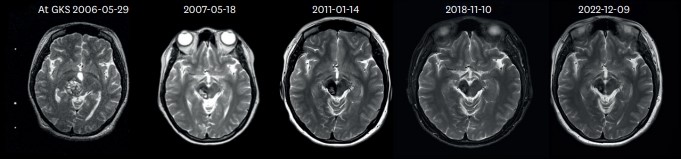 显示伽玛刀放射手术（GKS）后右侧中脑海绵状血管瘤大小变化的MRI：手术后脑海绵状血管瘤逐渐缩小，观察到体积减少和病变的消失