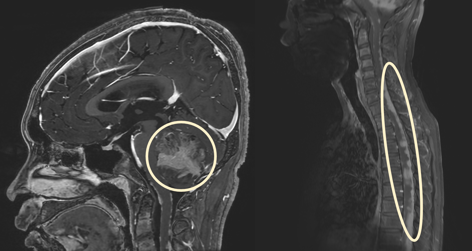 [사진] 수모세포종 환자의 뇌 및 척수 MRI. 