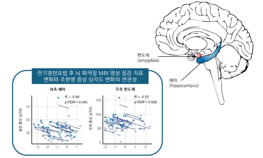 [그림] 전기경련요법 전후 해마와 편도체의 MRI 질감 지표 변화와 증상 심각도 변화의 연관성: