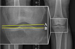 [X-ray 이미지] 관절선 수렴각: A선과 B선이 이루는 각도로 무릎 관절의 정렬 상태를 평가하는 지표로 사용됨