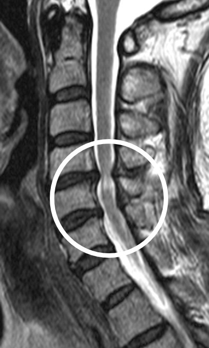 [사진] 경추척수증 환자의 경추 MRI