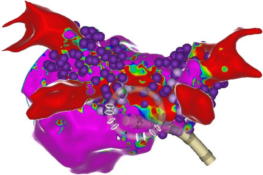 [그림] 심방세동 환자의 좌심방 구조를 3차원으로 시각화한 이미지. 보라색 구체는 펄스장 절제술로 치료가 완료된 부위를 나타냄