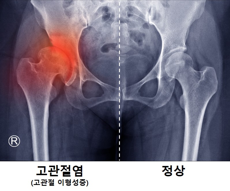 [사진] 고관절 이형성증으로 인한 고관절염 환자의 X-Ray. 비구가 대퇴골두를 과도하게 덮거나 충분히 덮지 않으면 고관절염이 발생함