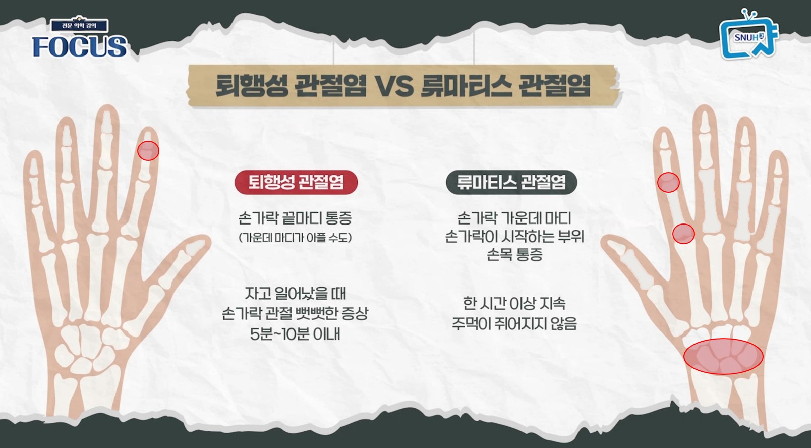 [자료2] 퇴행성 관절염 VS 류마티스 관절염