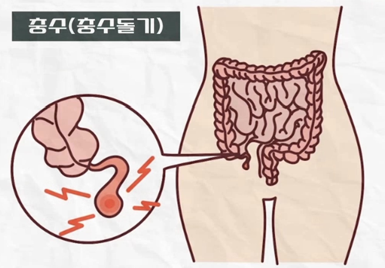 대장끝에 위치한 돌기 사진