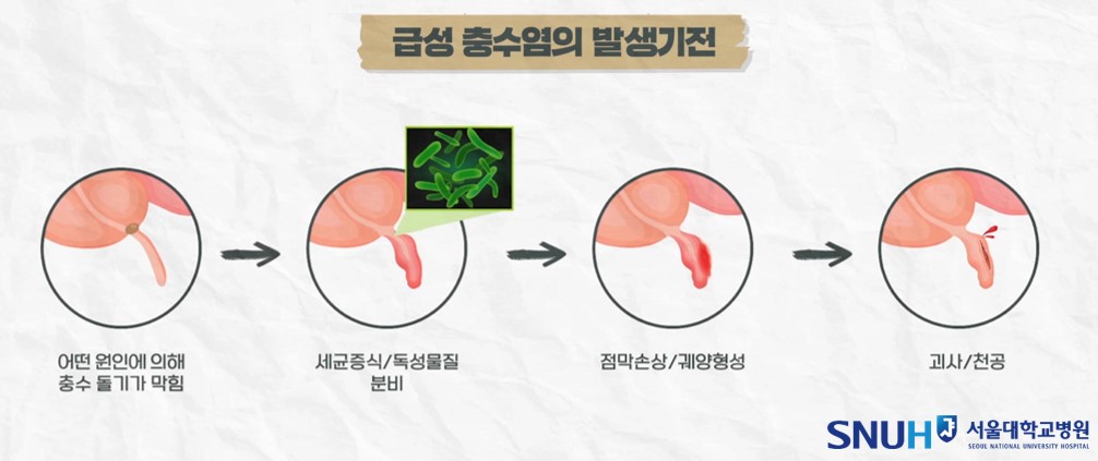 충수 돌기가 막히고 세균증식, 점막손상, 궤양, 괴사로 이어지는 경과