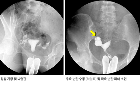 자궁 나팔관 조영검사 사진