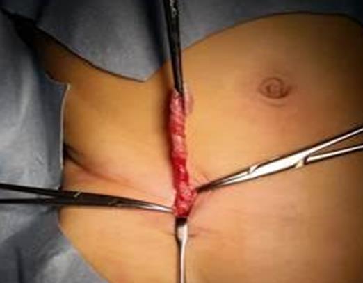절개 탈장 교정술