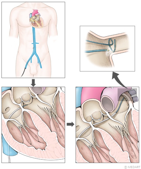 심방세동의 전극도자절제술