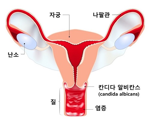 칸디다성 질염