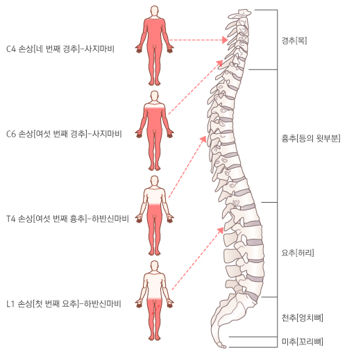 척추 손상 위치와 마비 범위