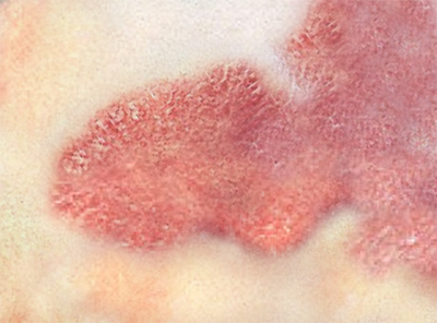 나종한센병의 피부병변