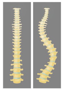 정상인과 척추측만증 환자의 차이