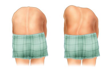 등을 구부렸을 때 정상인과 척추측만증 환자의 차이