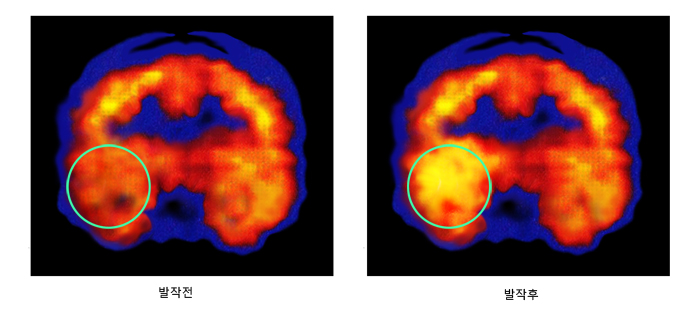 우측 측두엽 뇌전증 환자의 단일광자방출 단층촬영