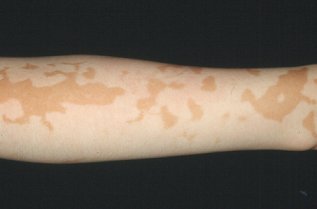 백반증의 피부 병변