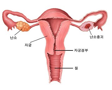 난소 종괴 위치
