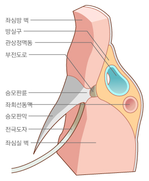 좌심방과 좌심실 사이에 있는 부전도로의 모식도