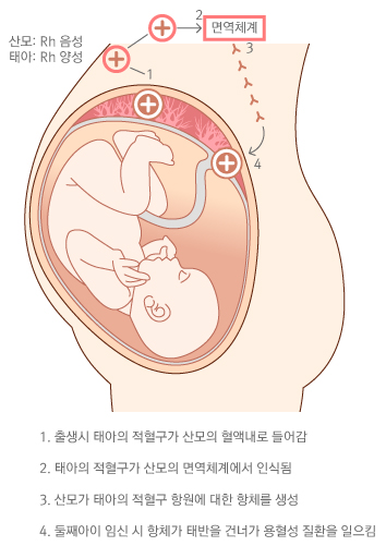 신생아 용혈성 질환