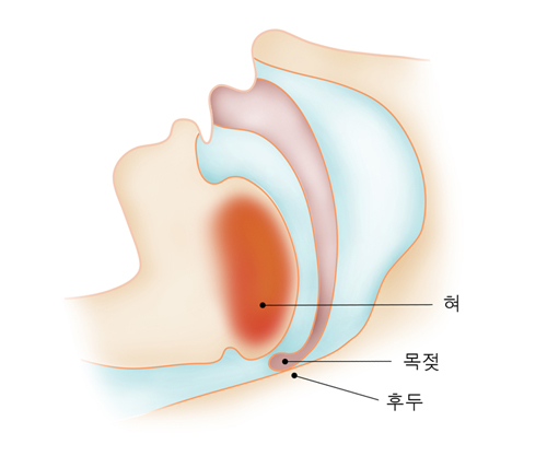 코골이 환자의 기도
