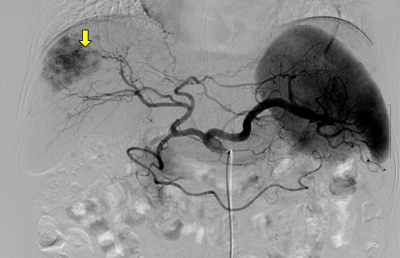 혈관조영검사에서 나타난 간암