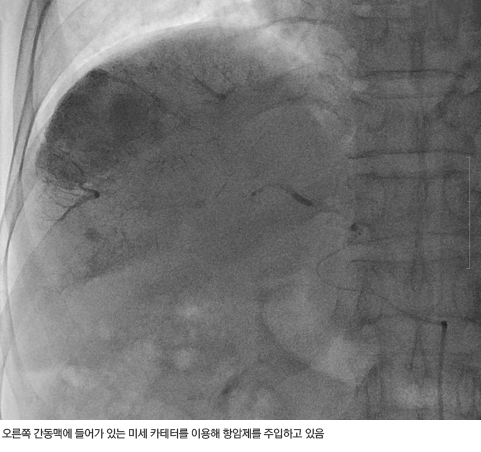 간암 화학색전술로 간암을 치료하는 과정